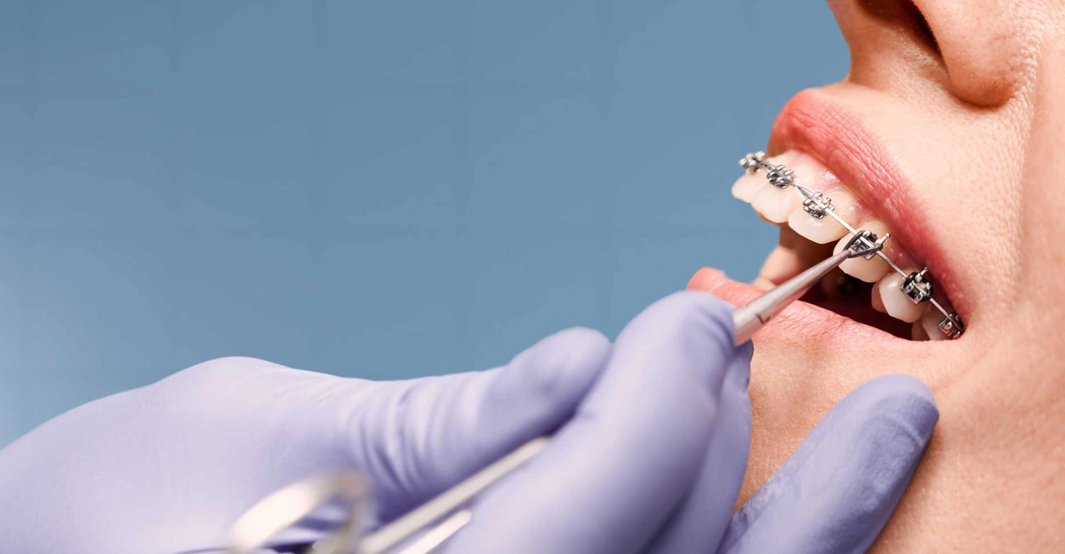 what counts as orthodontic treatment inblog